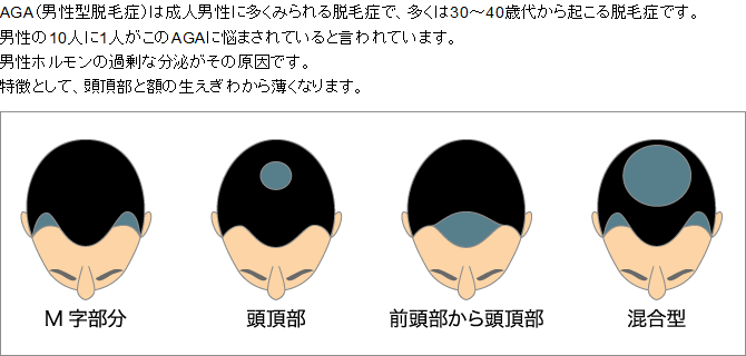 M字部分・頭頂部・前頭部から頭頂部・混合型