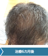 50代症例写真：治療6カ月後