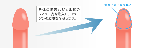 亀頭増大・亀頭強化治療