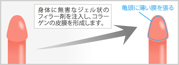 亀頭増大・亀頭強化治療