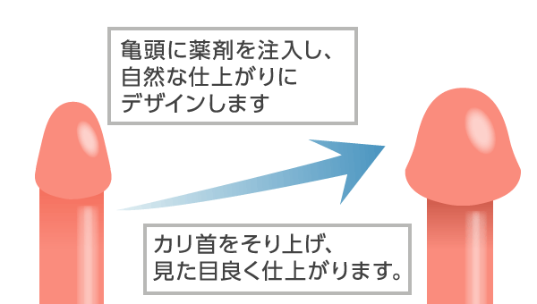 ペニス増大治療