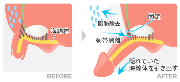 長茎術(ちょうけいじゅつ)